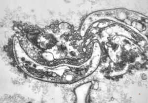 M,50y. | Pneumocystis carinii M,50y. | Pneumocystis carinii